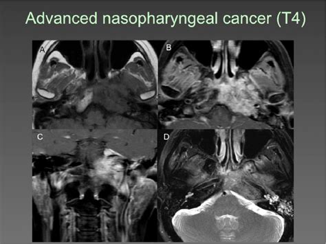 The Clivus Lesions Crossroads Of Skull Base Semantic Scholar