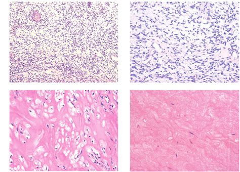 Pathological examination of gastric gastrointestinal stromal tumor ...