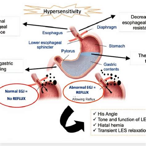 The Complex Pathogenesis Of Gerd Egj Esophagogastric Junction Les Download Scientific