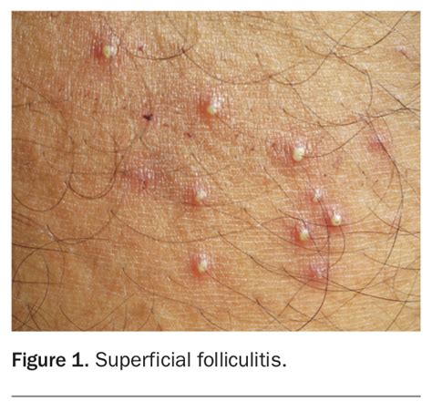 Folliculitis Genital Area