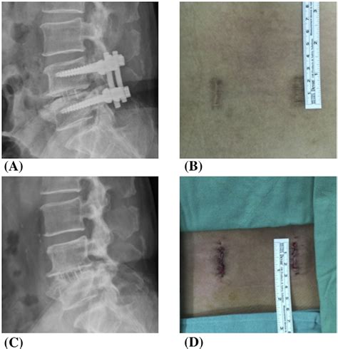 Figure 1 From Removal Of Fixation Construct Could Mitigate Adjacent Segment Stress After