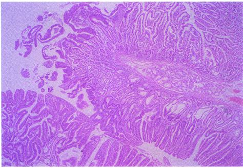 Photomicrograph Of Adenocarcinoma Of Duodenum Involving Papilla Of