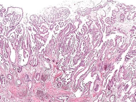 Histology of mucinous adenocarcinoma of the colon (patient B; T 2 N 0 ...