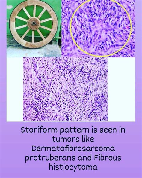 Clue: a Benign Tumor Made Up of Muscle Tissue