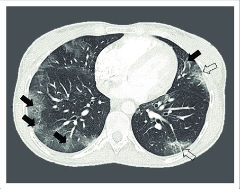 Axial Ct Lung Window Of A 31 Year Old Female Patient With No