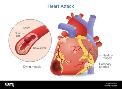 Blood Clot. Plaque Rupture And Blood Clot Formation, Heart Muscle ...