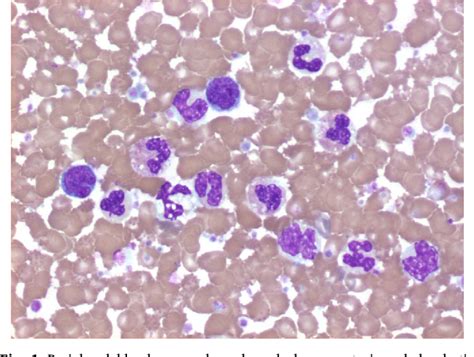 Figure 1 From Chronic Myelomonocytic Leukemia As A Transformation From