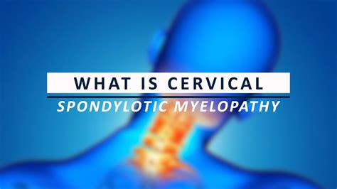 What Is Cervical Spondylotic Myelopathy Youtube