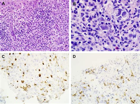 Hepatic Lymphoma Diagnosis Surgical Pathology Clinics