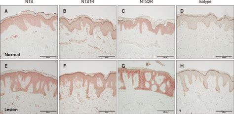 Immunohistochemistry Showing Difference In In Expression Of Neurotensin