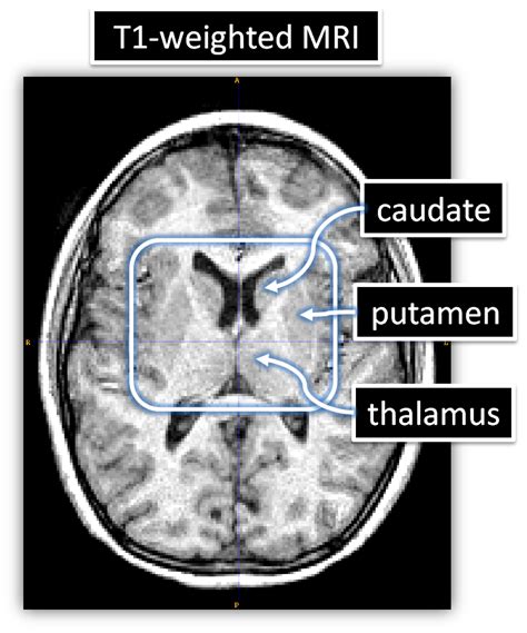 Suyash P Awate - Research