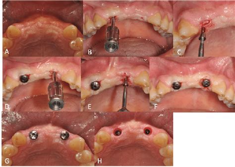 Fgiu Technique A Submerged Implant Area Weeks Healing Occlusal