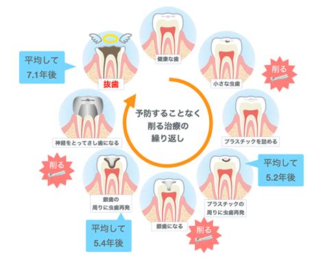 虫歯の治療って何回もできない 【土日も診療】春日three歯科・矯正歯科 福岡県春日市