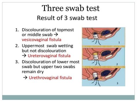 Genital Tract Fistula PPT