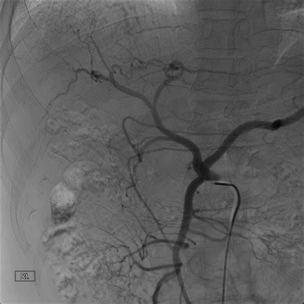 Angiogram Celiac Axis