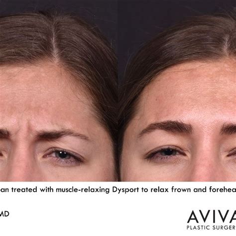 Forehead Neuromodulators Botox Dysport Artofit