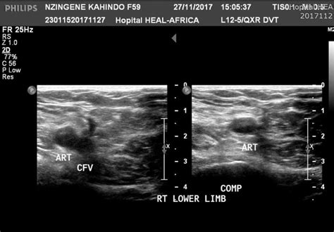 Blood Clot In Leg Ultrasound