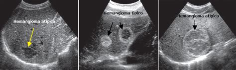 Ultrasonido Lesiones Focales Del H Gado Gastro M Rida