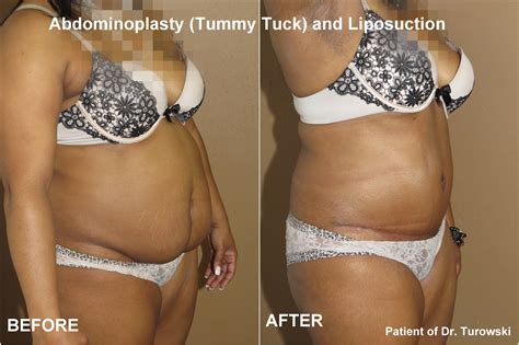 Tummy Tuck And Liposuction More Info And Photos Tummy Tuck Abdominoplasty