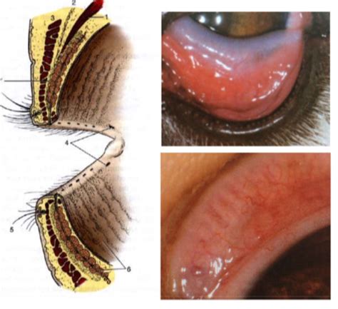 Eyelids And Conjunctiva Flashcards Quizlet