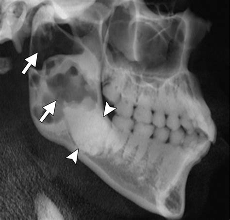 Radiopaque Jaw Lesions An Approach To The Differential Diagnosis