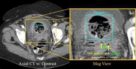 RadiologySpirit: Diverticulitis: Pelvic Abscess with Fistulae