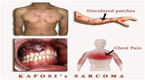 Kaposi Sarcoma