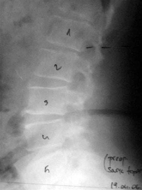 Preoperative lateral lumbar X-ray of the case. | Download Scientific Diagram