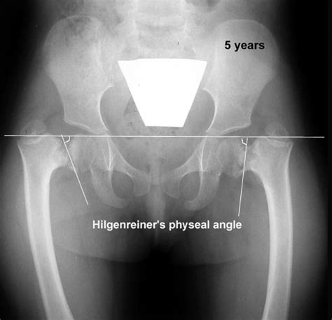 Developmental Coxa Vara - Pediatrics - Orthobullets