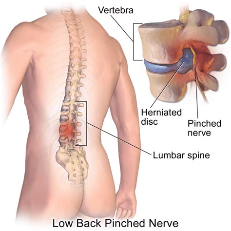 How to heal your lower back pain with exercise | MediSpera