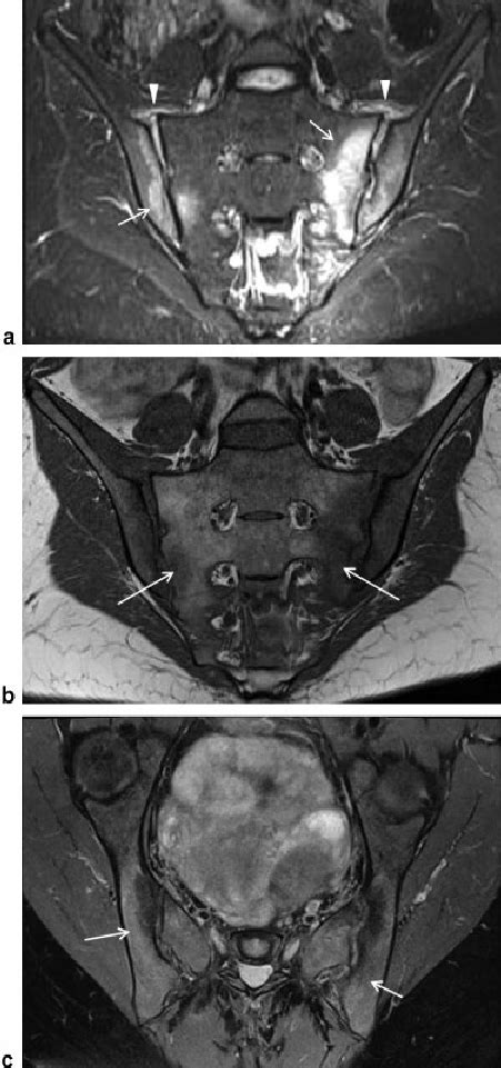 Sacroiliitis A Coronal Oblique And B Axial Short Tau Inversion