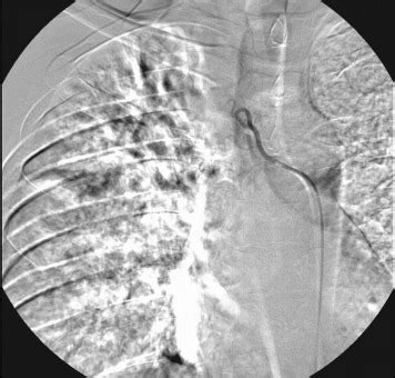 CT Guided Percutaneous Embolization Of A Rasmussen Aneurysm With