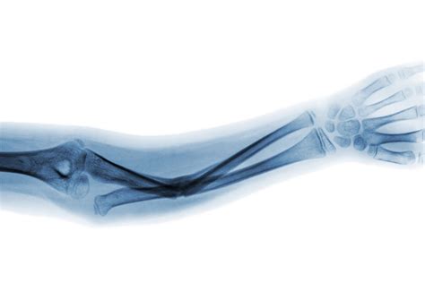 Possible causes and symptoms of a broken elbow – Hand Therapy Group