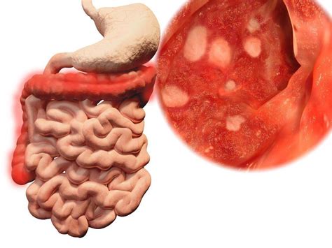 Colitis Ulcerosa im Überblick kanyo