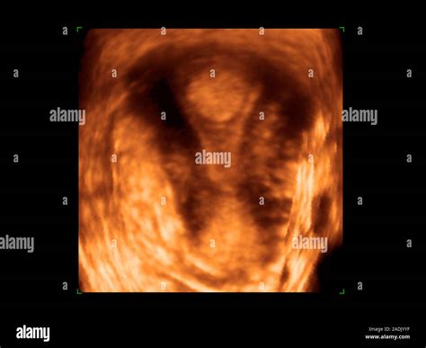 Endometrial Polyp Coloured 3 D Ultrasound Scan Of A Polyp Upper