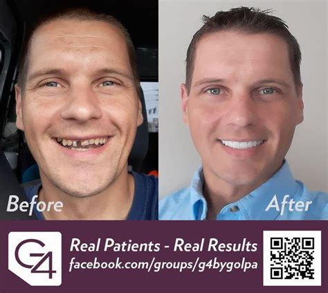 G4 By Golpa | Real Patients -Real Results | Implant dentistry, Dental ...