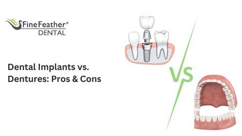 Dental Implants Vs Dentures Pros And Cons Artofit