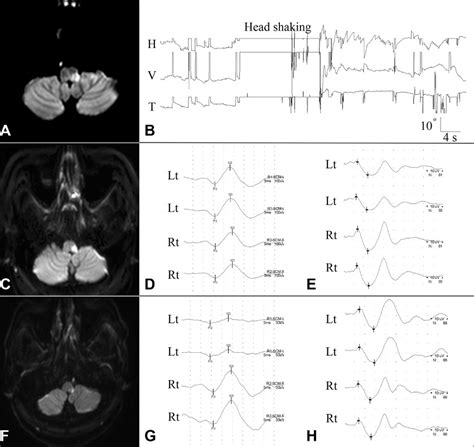 Patients With Left Lateral Medullary Infarction Show Contralesional