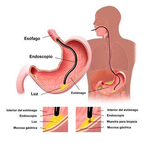 Endoscopia De V As Digestivas Altas Cigeo