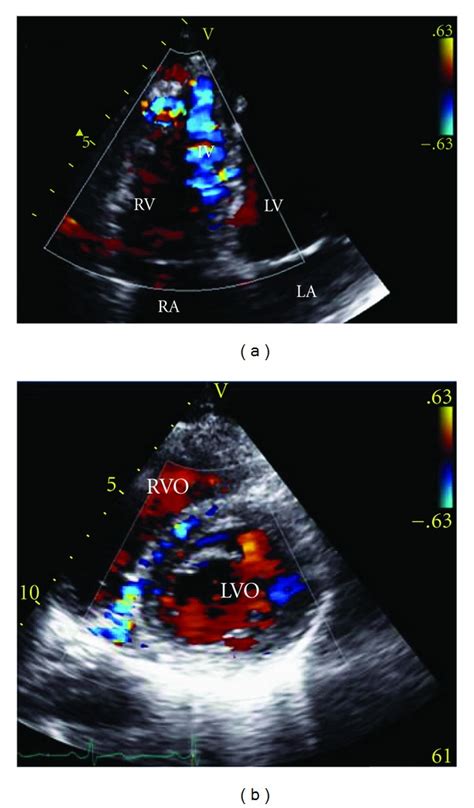 Transthoracic Colour Flow Doppler Echocardiography A Four Chamber