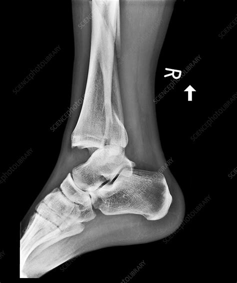 Fractured And Dislocated Ankle X Ray Stock Image C017 7976