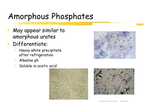 Amorphous Urates In Urine