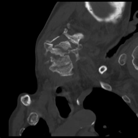 Torticollis Image