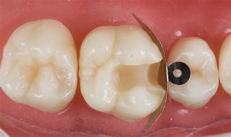 Closing The Class Restoration Box Part Management Of Direct Resin