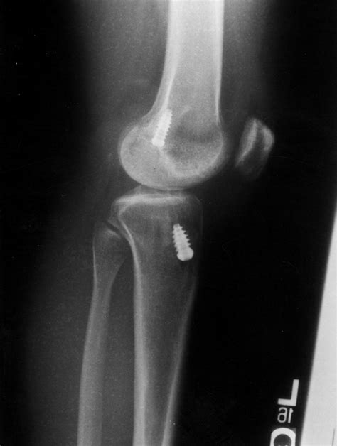 A Symptomatic Cyclops Lesion 4 Years After Anterior Cruciate Ligament