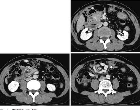 Figure 1 From An Adult Case Of Intestinal Malrotation Operated After Chronic Symptoms Persisted