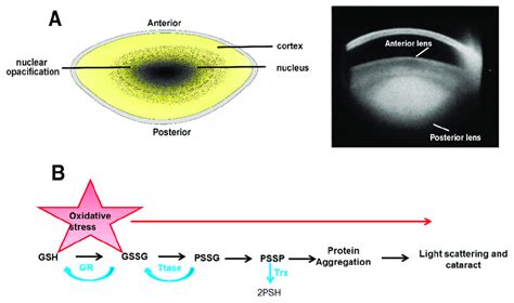 Nuclear Cataracts A Location Of The Nuclear Cataract Subtype Left