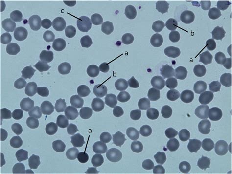 Photomicrograph of standard May Grünwald Giemsa stained peripheral