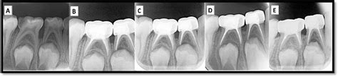 A Preoperative Intraoral Peri Apical IOPA Radiograph Of Lower Right