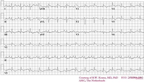 Pulmonary embolism electrocardiogram - wikidoc